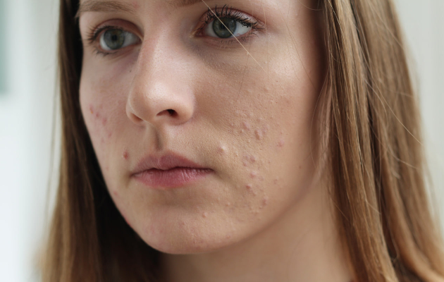 Лучшие способы лечения акне на лице