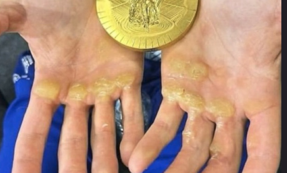 У румына на руках следы от золота ОИ, фото соцсети